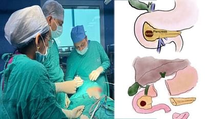 दिल्ली एम्स में विश्व की सबसे छोटी मरीज:अग्नाशय के कैंसर से पीड़ित बच्ची की बचाई जान,साढ़े आठ घंटे चली सर्जरी।